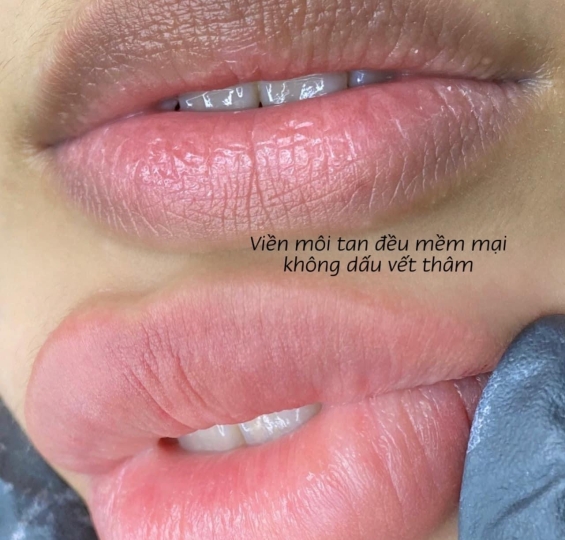 PHUN KHỬ THÂM MỨC ĐỘ NHẸ